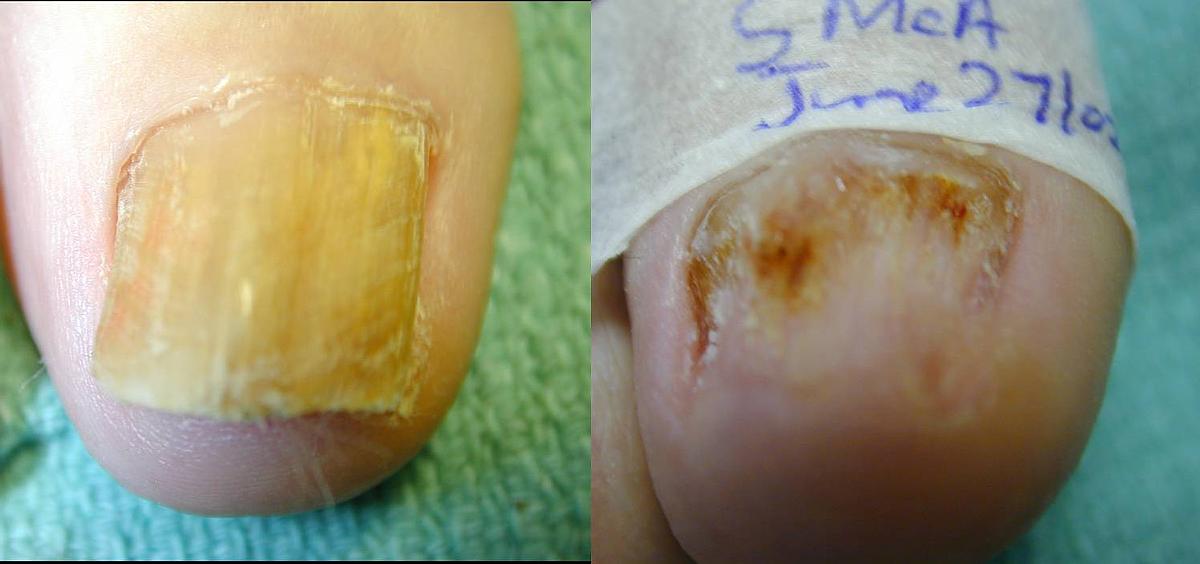 How I got rid of a fungal infection in my toenail
